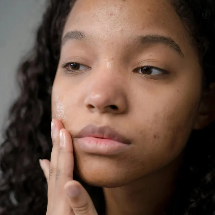 Acne & Skin Concerns